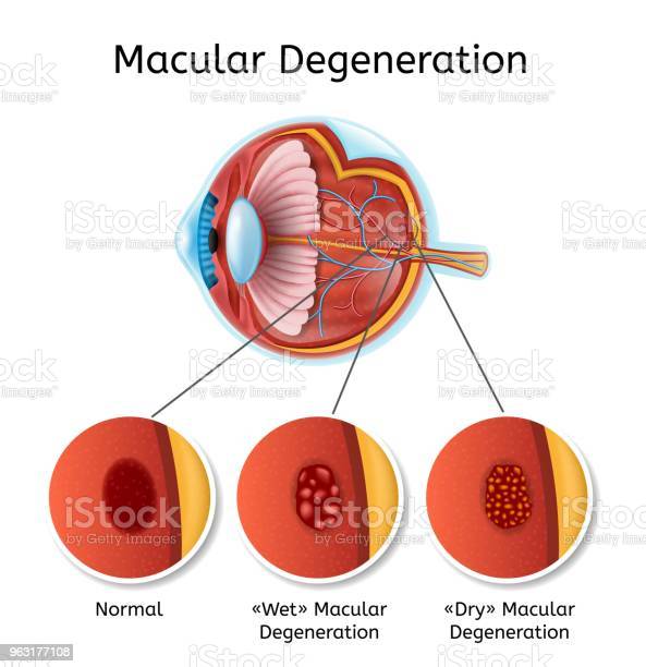 early symptoms of macular degeneration